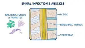 Image result for Spinal Infection