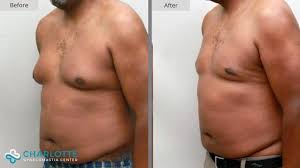 Image result for Gynecomastia