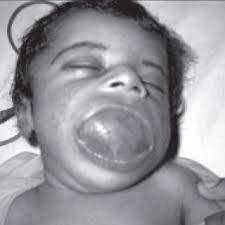 02 (4.71) eva continues the naughty evening with her friends Photograph Showing A Neonate With Open Mouth Due To A Cyst In The Tongue Download Scientific Diagram