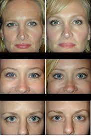 Maybe you would like to learn more about one of these? Reconsidering Eyebrow Results Sagging Eyebrow Surgery Working Amazed Their Women Botox Would Thi Botox Brow Lift Eyebrow Lift Surgery Eyebrow Lift