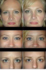 Learn how you can use botox to safely lift in your brow in this. Reconsidering Eyebrow Results Sagging Eyebrow Surgery Working Amazed Their Women Botox Would Thi Eyebrow Lift Surgery Botox Brow Lift Eyebrow Lift