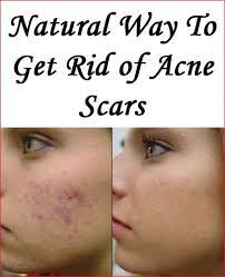 It doesn't just help heal damaged tissue, but soothes swollen skin, meaning those red acne scars can be reduced quickly. Pin On Wellness