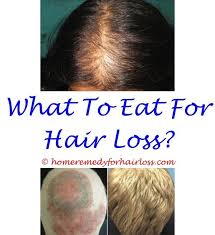 Pin On Hair Loss Vitamins