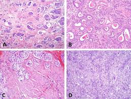 The pathologist checks the samples to see how similar the tumor tissue looks to normal prostate tissue. What Is The Significance Of Variant Histology In Urothelial Carcinoma European Urology Focus