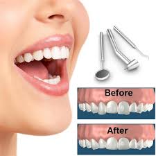 Permanent bicuspid teeth restorations will cost $184. Tooth Reshaping St Lawrence Dentistry