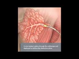 Sialendoscopy is an innovative technique that uses extremely narrow endoscopes to diagnose and treat many conditions of the salivary glands. Sialendoscopy Youtube