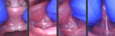 If you've never breastfed before, the sensation can be a little unusual. 4 Ways To Tell If Your Child Has A Tongue Tie And What To Do About It Alabama Tongue Tie Center Dr Richard Baxter Birmingham Al
