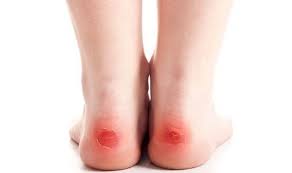 Check spelling or type a new query. How To Get Rid Of A Blood Blister The 4 Things To Avoid Express Co Uk
