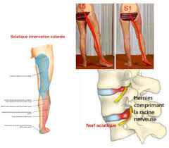 Nicole et laurence restent à l'école entre midi et une heure trente, comme moi. Paresthesies Cuisse Orthopedie Pour Tous