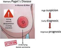 Paget S Disease Of The Male Breast An Unusual Case In A Young Man And Literature Review Sciencedirect