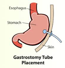 Department Of Surgery Gastrostomy Tubes