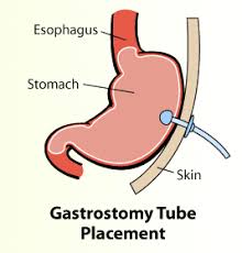 department of surgery gastrostomy tubes