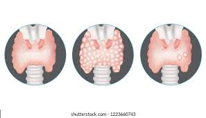 Image result for Multinodular Goiter