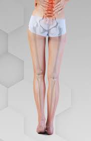Image result for Functional Leg Length Discrepancy