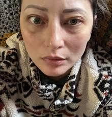 healing after blepharoplasty surgery