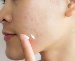 Looking For Acne Marks Removal Cream Choose From These Options looking for acne marks removal cream