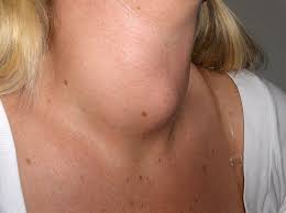 A cancer can grow into,or begin to push on nearby a cancer may also cause symptoms like fever, extreme tiredness (fatigue), or weight loss. When A Lump In The Neck Is Cause For Concern Lakeshore Ear Nose Throat Center Ear Nose Throat Doctors