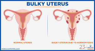 Stage iii or moderate stage: Bulky Uterus It S Symptoms Causes And Treatment Medicover Fertility
