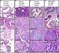 This review focuses on histopathological aspects of carcinoma of the prostate. Mechanisms Of Prostate Cancer Initiation And Progression Sciencedirect