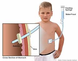 About Gastrostomy Tubes Gillette Children S Specialty Healthcare