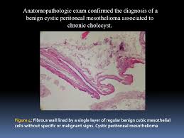 The final pathology revealed bmpm. Ppt Cystic Mesothelioma Of Gallbladder Lodge An Exceptional Location Powerpoint Presentation Id 4042031