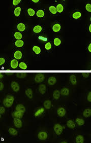 Image result for ANA Staining Pattern