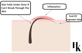 How to treat ingrown hairs after they show up? How To Avoid Ingrown Hairs Hk Wax Center Austin Arbor