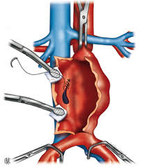 El aneurisma aórtico abdominal se produce con mayor frecuencia en personas entre 65 y 75 años de edad y son más comunes entre los hombres y los fumadores. Rupturas De Aneurisma De La Aorta Abdominal Tecnicas Especificas Sciencedirect
