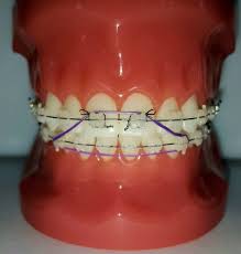 Hook the rubber band on the hook of the braces on the top teeth and pull the rubber band to the hook on the bottom teeth. Pin Em Rubber Bands