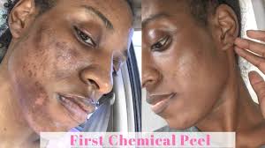 It is essential to practice strict sun avoidance during and after the. First Tca Chemical Peel Vlogmas Day 1 Youtube