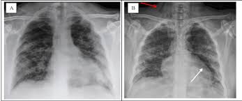 Check spelling or type a new query. Lung Complication In Covid 19 Convalescence A Spontaneous Pneumothorax And Pneumatocele Case Report