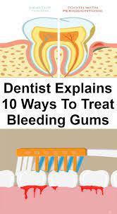 Dentist Explains 10 Ways To Treat Bleeding Gums In Lifestyle Bleeding Gum Gum Treatment Gum Disease