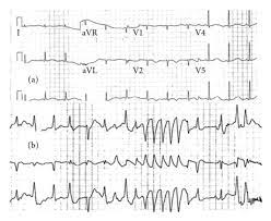 Cardiac arrest is a sudden loss of blood flow resulting from the failure of the heart to pump effectively. A Ecg After Cardiac Arrest Sinus Rhythm 68 Bpm Qtc 683 Ms B Download Scientific Diagram