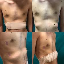 Pektus Klinik Prof Dr Mustafa Yuksel