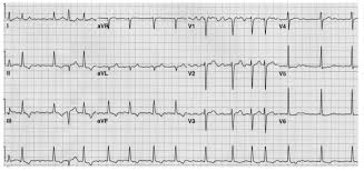 Supraventricular tachycardia (svt) is a very common cause of hospital admission and its diagnostic and treatment may be difficult sometimes. Simple Education