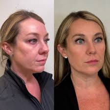 Honored to have been invited to attend the Allergan Advanced Applied  Anatomy hands-on cadaver course with the legendary Professor Sebastian  Cotofana. 🧠💉 This is my second time training with @cotofanaanatomy, the  world's