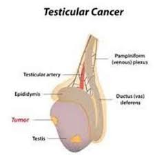 Other symptoms of testicular cancer usually do not appear until after the cancer has spread to other parts of the body. Management Of Early Stage Testicular Cancer Aua Guideline 2019