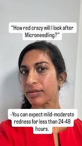 Often, the fear of how we will look and heal after a treatment is a barrier  to giving it a shot. This is me immediately after my Microneedling +  Amregen stem cell infusion. Redness doesn’t last long ...