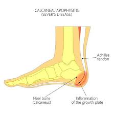 Image result for Calcaneal Apophysitis