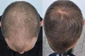 Hair Transplants Video Coconut Oil Baldness Hair Loss Goingbaldandbaldingheads Hairtransplant Hairlossmenre Help Hair Loss Hair Loss Remedies Stop Hair Loss