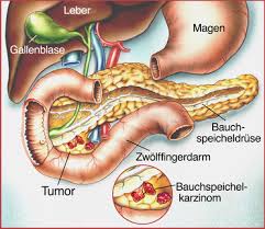 Bauchspeicheldrusenkrebs Pankreaskarzinom Ursachen Symptome Behandlung Medlexi De