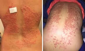 Maybe you would like to learn more about one of these? Keto Rash Utslag Fran Ketos Next Level Biohacking