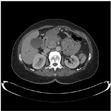 Aspiration and multidetector spiral ct in the diagnosis. Ct Of The Large Locally Advanced Pancreatic Cancer Encasing The Download Scientific Diagram