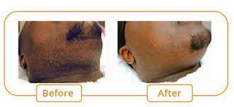 Yag laser technology —which is what we use— is the best for providing safe and effective laser hair removal treatments. Hair Removal For Pigmented Skin Medime Institut De Medecine Esthetique De Montreal