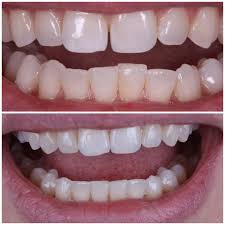 Soaking aligners in denture or retainer cleaning solution My Invisalign Diary Weeks 1 21 Homegirl Hygienist