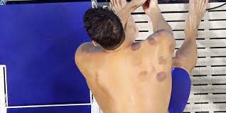 Jul 15, 2021 · michael phelps verbringt einen großen teil seiner zeit damit, im pool zu trainieren. Olympia 2016 Warum Hat Michael Phelps Rote Flecken Am Korper Kolner Stadt Anzeiger