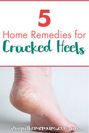 Summer leaves feet cracked and dry. 5 Home Remedies For Cracked Heels