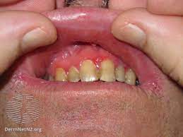 You can also buy some toothache medicine which will help much better or even use some orajel on the toothache. Tooth Pain Causes Treatment And When To See A Doctor