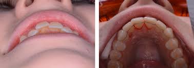 Inman aligner seeks more attention among many people in the uk. Inman Aligner Treatment Winchester Solutions Dental Clinic