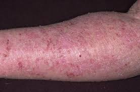 Image result for Atopic eczema atopic dermatitis